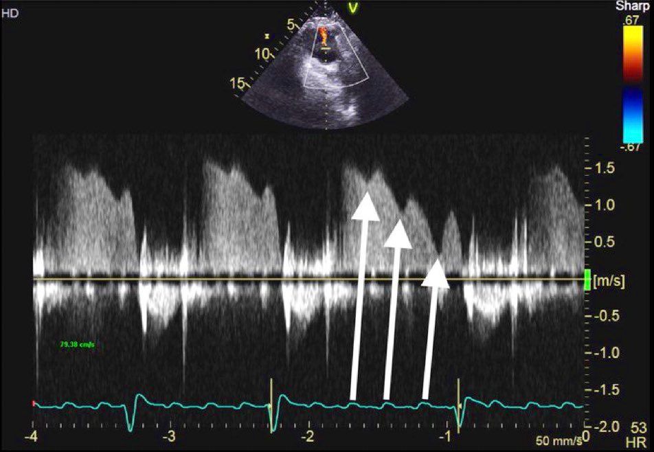 𝐏𝐮𝐥𝐦𝐨𝐧𝐚𝐫𝐲 𝐫𝐞𝐠𝐮𝐫𝐠𝐢𝐭𝐚𝐭𝐢𝐨𝐧 𝐣𝐞𝐭 𝐢𝐧𝐭𝐞𝐫𝐫𝐮𝐩𝐭𝐞𝐝 𝐛𝐲 𝐚𝐭𝐫𝐢𝐚𝐥 𝐟𝐥𝐮𝐭𝐭𝐞𝐫 𝐢𝐧𝐝𝐮𝐜𝐞𝐝 𝐑𝐀 𝐤𝐢𝐜𝐤𝐬:
𝐑𝐀 𝐜𝐨𝐧𝐭𝐫𝐚𝐜𝐭𝐢𝐨𝐧—&gt;⬆️𝐑𝐕 𝐩𝐫𝐞𝐬𝐬𝐮𝐫𝐞—&gt;⬇️𝐏𝐀-𝐑𝐕 𝐝𝐢𝐚𝐬𝐭𝐨𝐥𝐢𝐜 𝐠𝐫𝐚𝐝𝐢𝐞𝐧𝐭—&gt; 𝐈𝐧𝐭𝐞𝐫𝐫𝐮𝐩𝐭𝐞𝐝 𝐏𝐑 𝐣𝐞𝐭.
