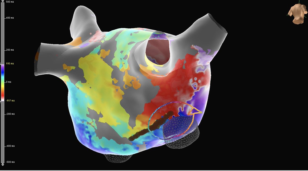 MitriJessica's tweet photo. Atypical left atrial Flutter post AFib ablation. Unique power of #HDGrid with #OTNearField quickly identified this unexpected circuit. Arrhythmia terminated with #TactiCathSE. 
Sameer Satija, MD @HCAFLHealthcare
#abbottproud #EnsiteX #EPeeps https://t.co/Z2qgHYw1RI