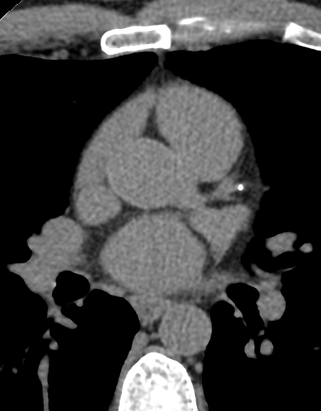 @MountSinaiChestRadiology (@mountsinaichest) on Twitter photo Do not call this mild coronary calcification in a 40 year old female! This is PREMATURE and would correlate with >95th percentile for her age and gender. Most important finding on this nonsense nodule f/u CT. <a href="/MountSinaiHeart/">Mount Sinai Fuster Heart Hospital</a> <a href="/MountSinaiDMIR/">Mount Sinai Diag, Molecular, and Interv Radiology</a> <a href="/MountSinaiDR/">Mount Sinai Radiology Residency</a> <a href="/mswradiology/">Mount Sinai West Radiology</a> <a href="/RofskyMD/">Neil Rofsky, MD, MHA</a> Do not call this mild coronary calcification in a 40 year old female! This is PREMATURE and would correlate with >95th percentile for her age and gender. Most important finding on this nonsense nodule f/u CT. <a href="/MountSinaiHeart/">Mount Sinai Fuster Heart Hospital</a> <a href="/MountSinaiDMIR/">Mount Sinai Diag, Molecular, and Interv Radiology</a> <a href="/MountSinaiDR/">Mount Sinai Radiology Residency</a> <a href="/mswradiology/">Mount Sinai West Radiology</a> <a href="/RofskyMD/">Neil Rofsky, MD, MHA</a>