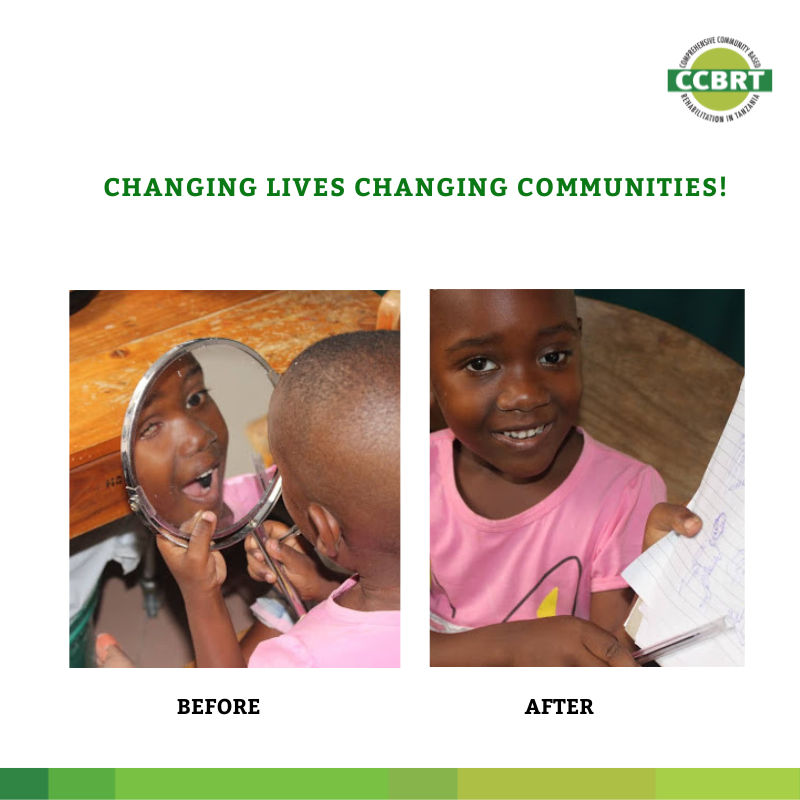 Loreen (8) years old, was born without one eye; CCBRT made her an artificial eye, giving her a good look  and avoid  bullying. She is  now  in class three.

Part of the profit from CCBRT's private services contributes to the free treatment of our colleagues. Call us: 0800110200.