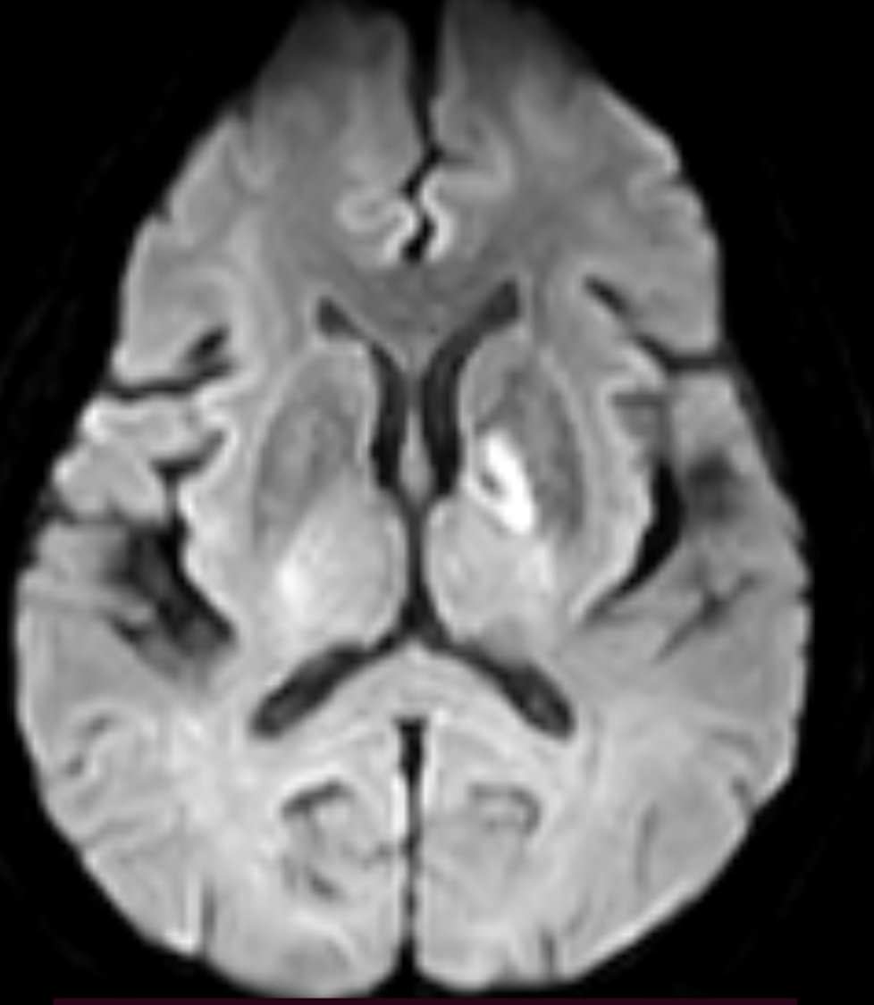 Anterior choroidal Artery stroke- triad of hemiparesis + hemianaesthesia + hemianopia. Movement disorders include new-onset parkinsonism,  choreoathetosis or posterior variant of alien limb syndrome. This lady developed unilateral Rt sided parkinsonism  2 weeks after AchA stroke