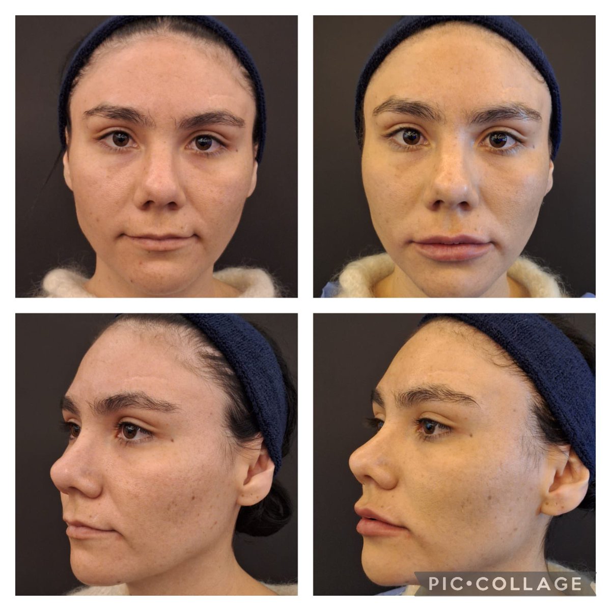 For beautiful and natural #lips #aliaxin LV #ibsa #haderma <a href="/Medikas1/">Medikas</a>