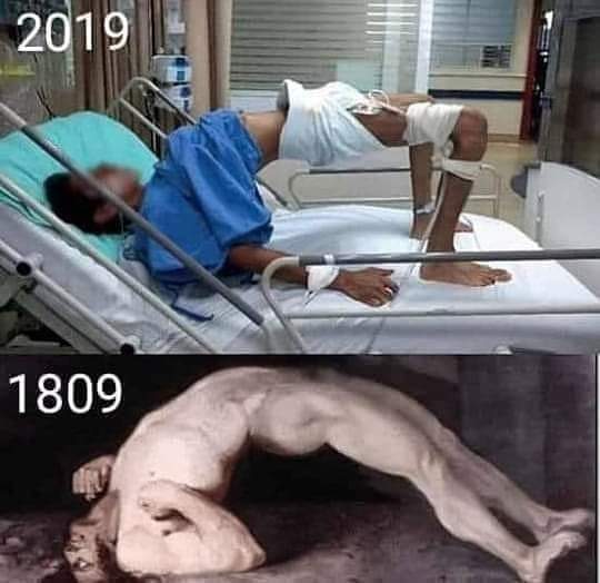 Hace poco más de 2 siglos se creía en las 'posesiones demoníacas', debido a la repentina contracción muscular y rígidez que sufrían las personas. 

Hoy en día se sabe que el TÉTANOS es causado por la bacteria Clostridium Tetanis que afecta al sistema nervioso. 

La posición