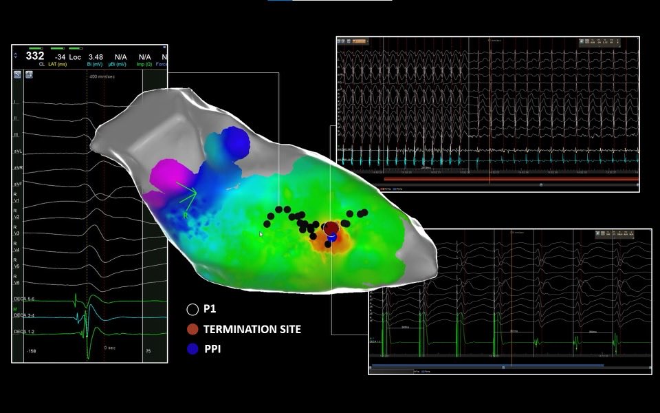 Fascicular VT ablation - multiple sites with prox to distal P1 - concealed entrainment (blue dot) and termination after 3sec. ⁦@DimAsvestas⁩ M. Vavouris- ⁦@V_Michopoulos⁩