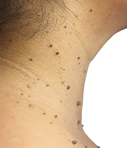 İnsulin direncinin ve buna bağlı  ileri yıllarda kalb-damar hastalığı ve diyabet gelişeceğinin güçlü ve pratik bir göstergesi.
Adı "SKIN TAG"
Boyun etrafı, koltuk altı, kadınlarda göğüs altında  yumuşak, sütlü kahverengi, sanki bir sapı varmış gibi değişik büyüklükte görülebilir.