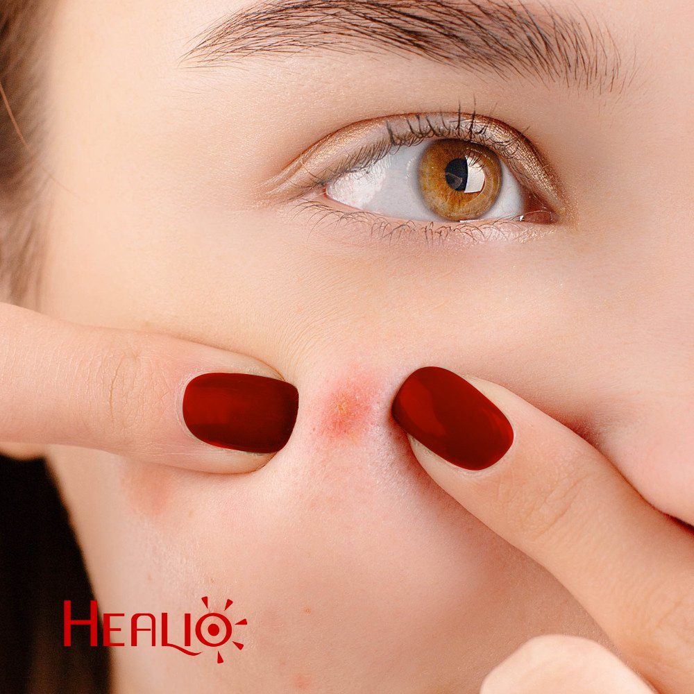 Healio_uk's tweet photo. Are you having acne problem?
#healio #healiouk #redlighttherapy https://t.co/pUvlD2Iee1
