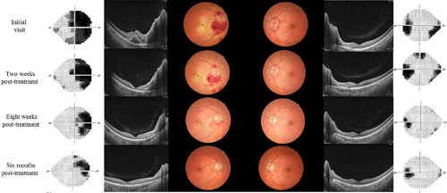 OphthaKarger's tweet photo. Optic Nerve Sheath Fenestration as Adjuvant Treatment for Severe Pseudotumor Cerebri Syndrome Induced by All-Trans Retinoic Acid
โก๏ธ https://t.co/f51ASMbU5r
โ๏ธ Hokazono K. et al.
๐ #CaseRepOphthalmol
#OpenAccess https://t.co/GR5PjuSc6O