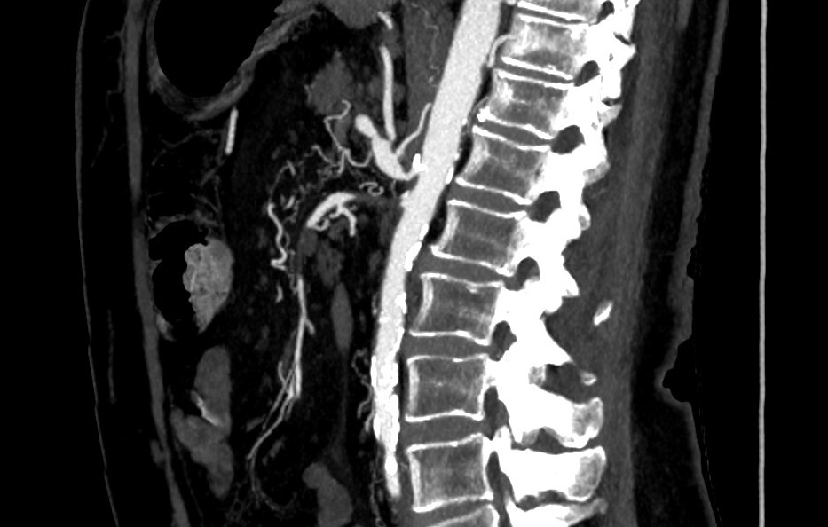 RVIchuac's tweet photo. Mujer de 64 años que acude por clínica compatible con angina mesentérica.

Se solicita TC: https://t.co/AlkcOMamiQ