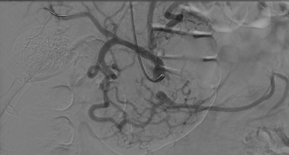 RVIchuac's tweet photo. Tratamiento endovascular:
Angioplastia y stents en arteria hepática, tronco celíaco y arteria renal derecha. https://t.co/77Uyy0QqGf