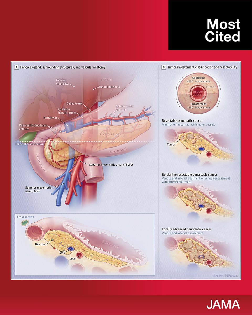 JAMA_current's tweet photo. One of our most cited articles of 2021, “Pancreatic Cancer | A Review,” summarizes evidence regarding pathobiology, diagnosis, and management of pancreatic ductal adenocarcinoma.

https://t.co/KdwVP7l1Js https://t.co/ZfbRP3sXH7