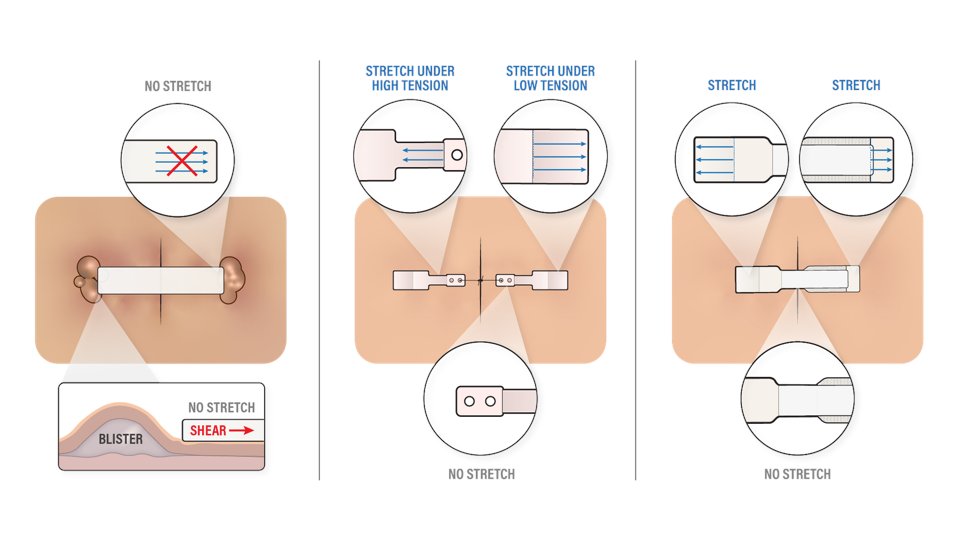 HEMIGARD disperses stress from wound edges using DIFFERENTIAL STIFFNESS: stiff near the wound and stretchy at the opposite end to reduce shear-induced blistering. Used by foot &amp; ankle, plastic and Mohs surgeons throughout US to improve outcomes. #hemigard #differentialstiffness
