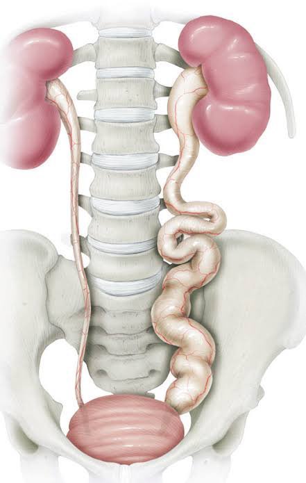 siupurol's tweet image. #MEGAURETER sinónimo de uréter dilatado
🔘Uréter con diámetro &amp;gt;7 mm desde las 31 SDG
🔘90% resuelven espontáneamente
🔘La mayoría son asintomáticos
🔘Indicaciones quirúrgicas➡️ px🧒🏻 sintomáticos, 📉disminución de función renal,  hidroureteronefrosis masiva #UROTips #SoMe4PedSurg