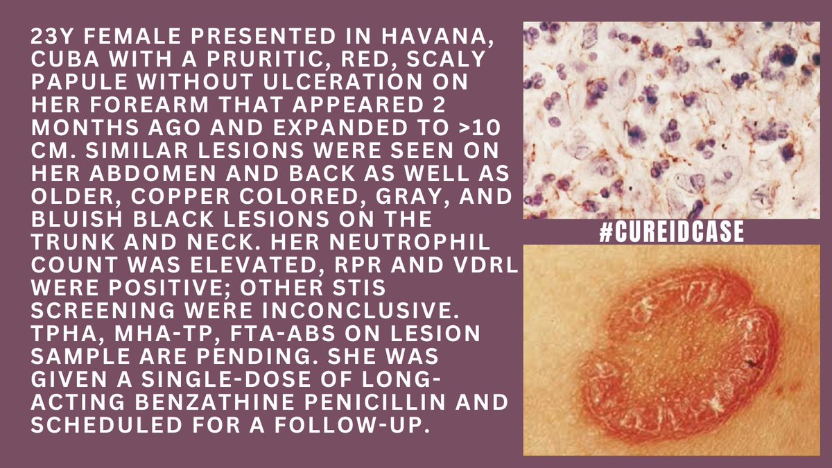 id_cure's tweet photo. #CUREIDCase What is your diagnosis? How would you treat this case? Find more details on CURE ID that will help you make the correct diagnosis:
https://t.co/LcOyhP4VZF
#IDTwitter #IDMedEd #MedEd #IDCase #CUREID https://t.co/vvijW3BL1X