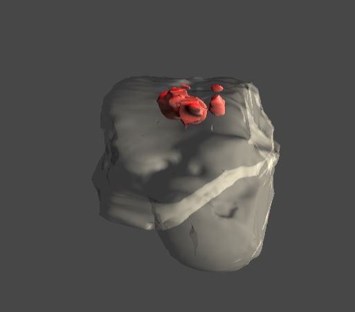 DraIsaGuillen's tweet photo. Sabéis como planificamos nuestras cirugías con tecnología 3D? Aquí os dejo un modelo de lesión #osteocondral en #astragalo. Con este estudio planificamos la mejor vía de abordaje de la lesión. #cartilago @clinicacemtro https://t.co/KSO6syH1uv