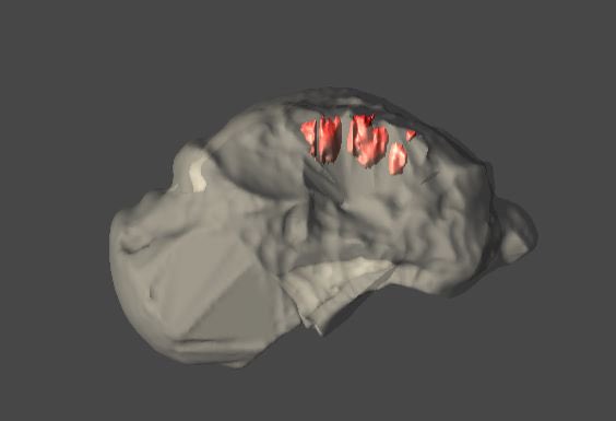 DraIsaGuillen's tweet photo. Sabéis como planificamos nuestras cirugías con tecnología 3D? Aquí os dejo un modelo de lesión #osteocondral en #astragalo. Con este estudio planificamos la mejor vía de abordaje de la lesión. #cartilago @clinicacemtro https://t.co/KSO6syH1uv
