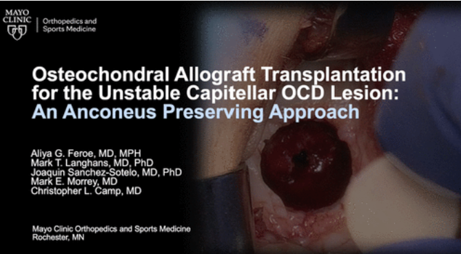 New from #VJSM and @MayoClinic! Osteochondral allograft transplantation using an anconeus-preserving approach is a reliable option for surgical management of unstable OCD lesions. @AliyaFeroeMD @JSanchezSotelo @ChrisCampMD Check it out! ow.ly/HYXU50Pa4rk