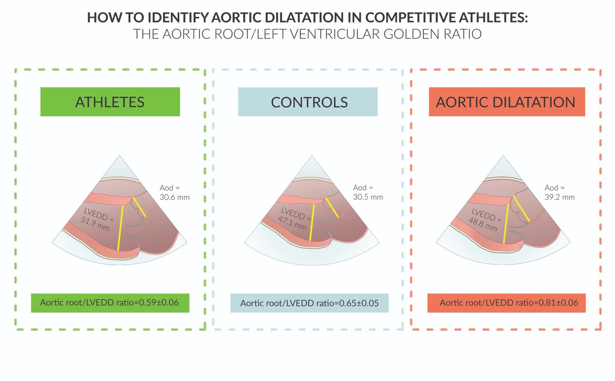 When do your eyes define an aorta as dilated? Here you'll find the answer! Aortic root/left ventricular diameters golden ratio in athlete's heart pubmed.ncbi.nlm.nih.gov/37480998/ @CavigliLuna @GLRagazzoni @Matte_Cameli @CardiouniSiena @unisiena @AouSenese