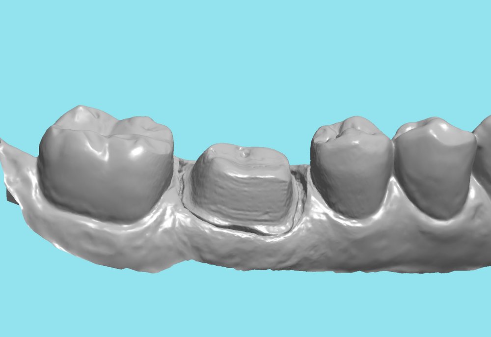 ddldental's tweet photo. When scanning the margins, remember that tissue and tooth structure look the same to a scanner. Clean the margins with a micro brush.

https://t.co/EqLEy4Kyz2

#digitaldentistry https://t.co/MrouXxpDxV