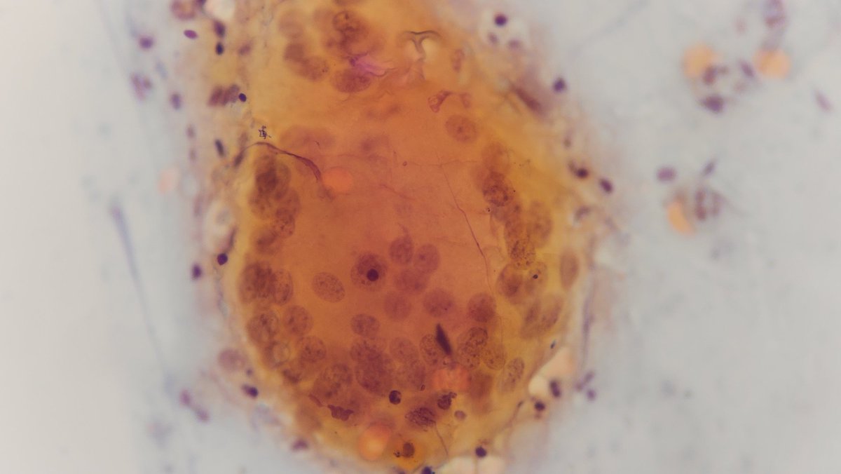 juanpapa_2155's tweet photo. Pap smear,  Giant cell in an atrophy context. #cytology #citologia https://t.co/ppe0ctxufD