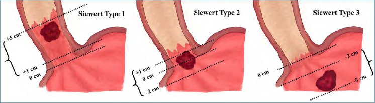 drdeepakmadhu's tweet photo. ✳️Seiwert types of EGJ carcinomas 

✳️Useful for planning therapy 

✳️Do meticulous exam and report accurately in your endoscopy report 

🌟Distal end of palisade vessels is fairly accurate for GEJ
(Ref:https://t.co/abkcLHLDkZ) 

Pic courtesy: https://t.co/9jnOz0fFiB

#GItwitter https://t.co/gqoEJD0sn4