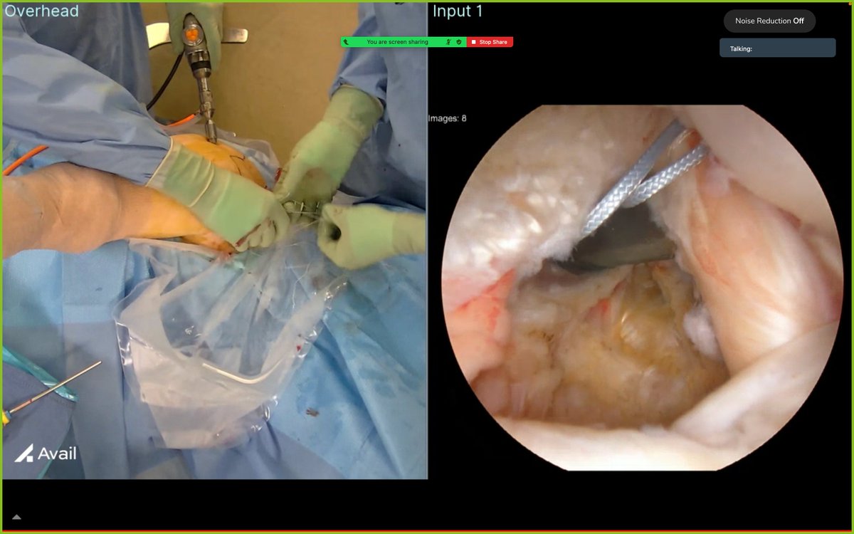 Avail Medsystems (@availmedsystems) on Twitter photo How many people can you fit in your OR?
Through the power of #Telepresence Avail gave thousands a front row seat to the OR for a REGENETEN Bioinductive Implant as part of <a href="/SmithNephewPLC/">Smith+Nephew</a>'s Advanced Health Solutions portfolio!👏
#Medtech #Innovation #OrthopedicSurgery How many people can you fit in your OR?
Through the power of #Telepresence Avail gave thousands a front row seat to the OR for a REGENETEN Bioinductive Implant as part of <a href="/SmithNephewPLC/">Smith+Nephew</a>'s Advanced Health Solutions portfolio!👏
#Medtech #Innovation #OrthopedicSurgery