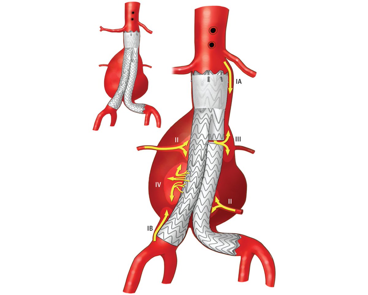 This narrative review describes the types of endoleak after endovascular aneurysm repair and updates on management recommendations. ja.ma/3OvlMv7