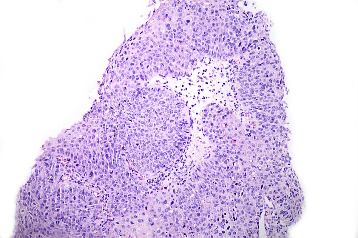 Be careful with this case. Tonsil of a man in the 4th decade. How would your diagnosis be?
#pathology 
#entpath