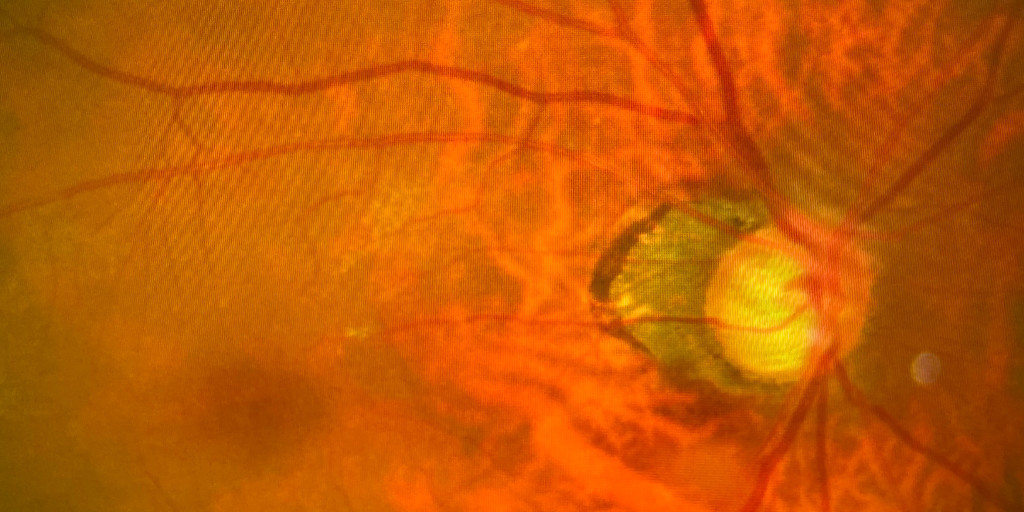 What would you do in this scenario? 

“I have a patient who was recently diagnosed with bilateral glaucoma with a visual field defect, do they need to notify the DVLA?"

Read the #ClinicalFile for our answer ➡️ bit.ly/3DgGAjz