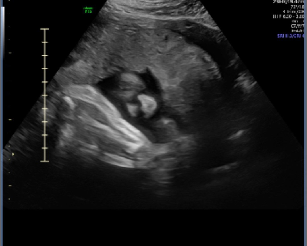 10 days and I get to meet my baby girl!! Nervously excited!