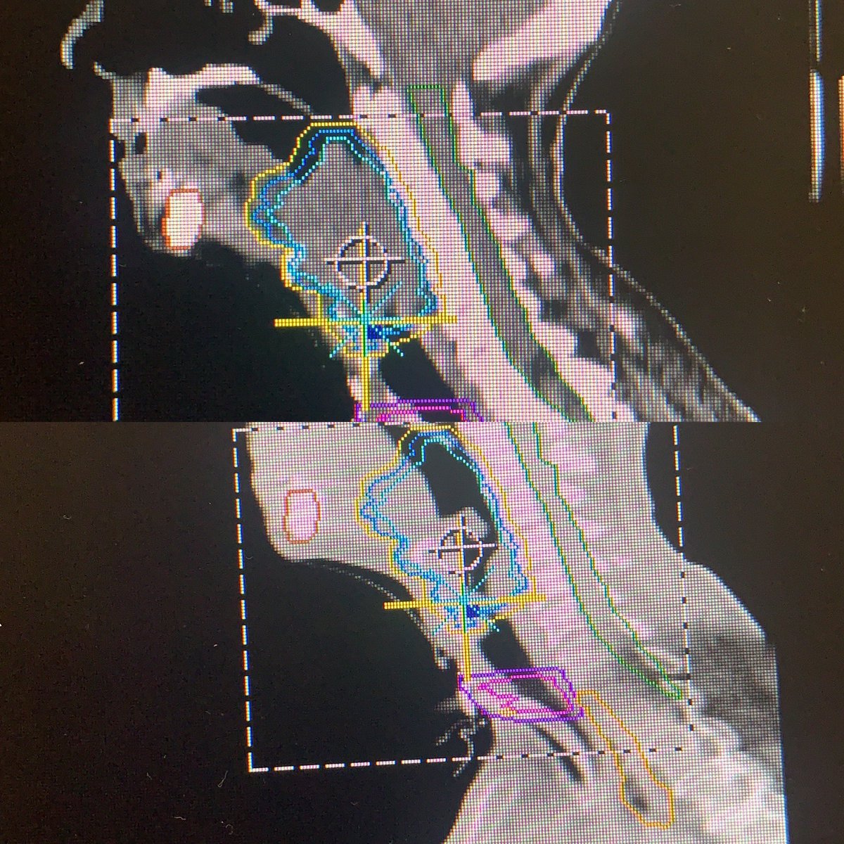oncoradioHUVM's tweet photo. #diamundialdelcancerdecabezaycuello
Un tipo de cáncer en el que pueden afectarse órganos fundamentales para hablar, deglutir y respirar. 
Por ello, la #radioterapia es un tratamiento fundamental para preservar todas estas funciones. Aportando además altas tasas de curación ☢️ https://t.co/yhsusepGFK