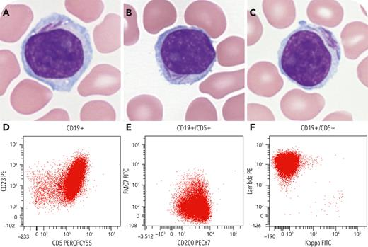 smbenlazar's tweet photo. Auer rod–like inclusions in chronic lymphocytic leukemia https://t.co/11Uv5lnw6G https://t.co/MikydhnszO
