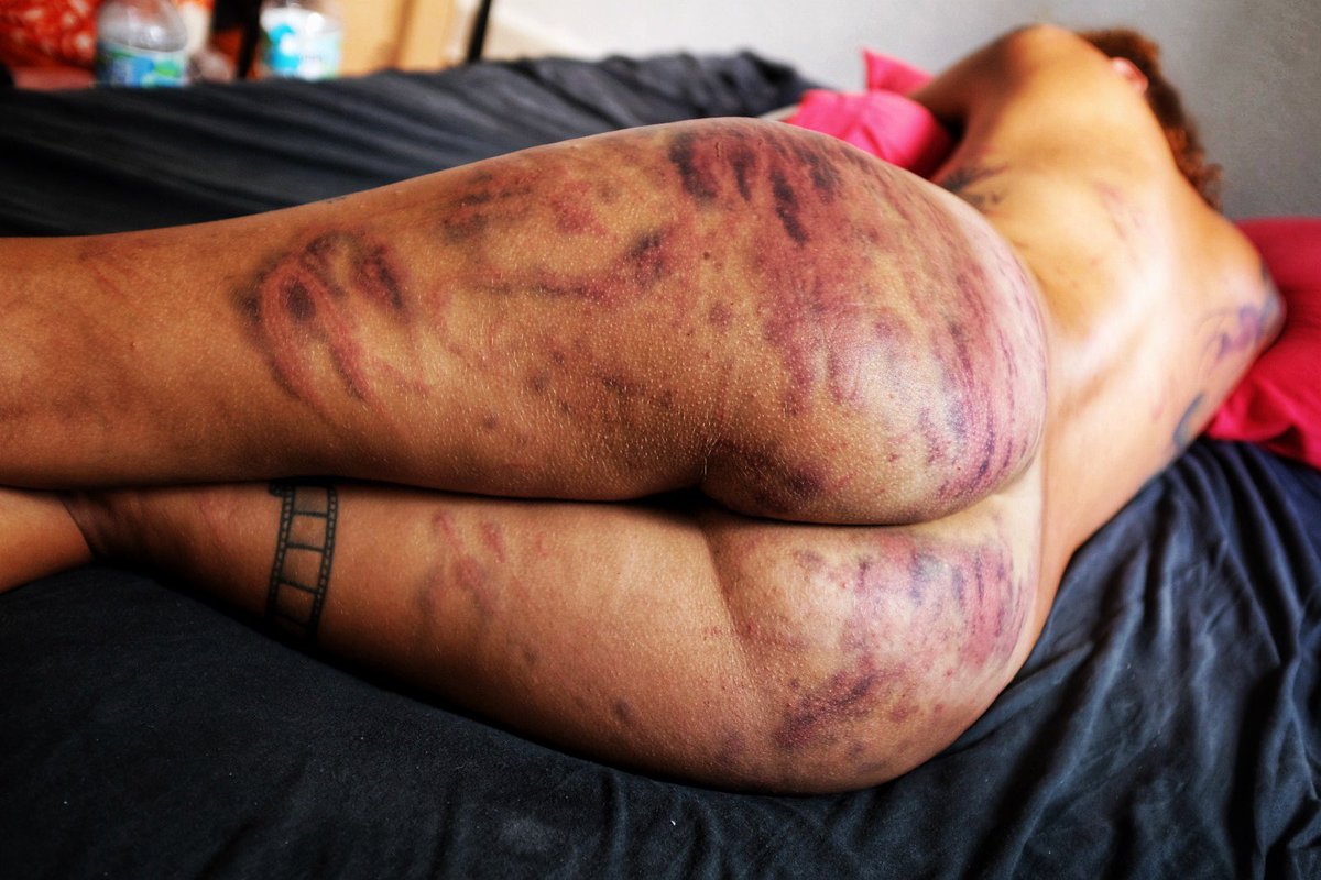 SadBlack20's tweet photo. #tbt @redhb_ my kinky teacher. luv u 4ever!

#impactplay #bdsm #bruises #spank #spanking #love #kinky #fetiche #ass https://t.co/4mzMEEmSUL