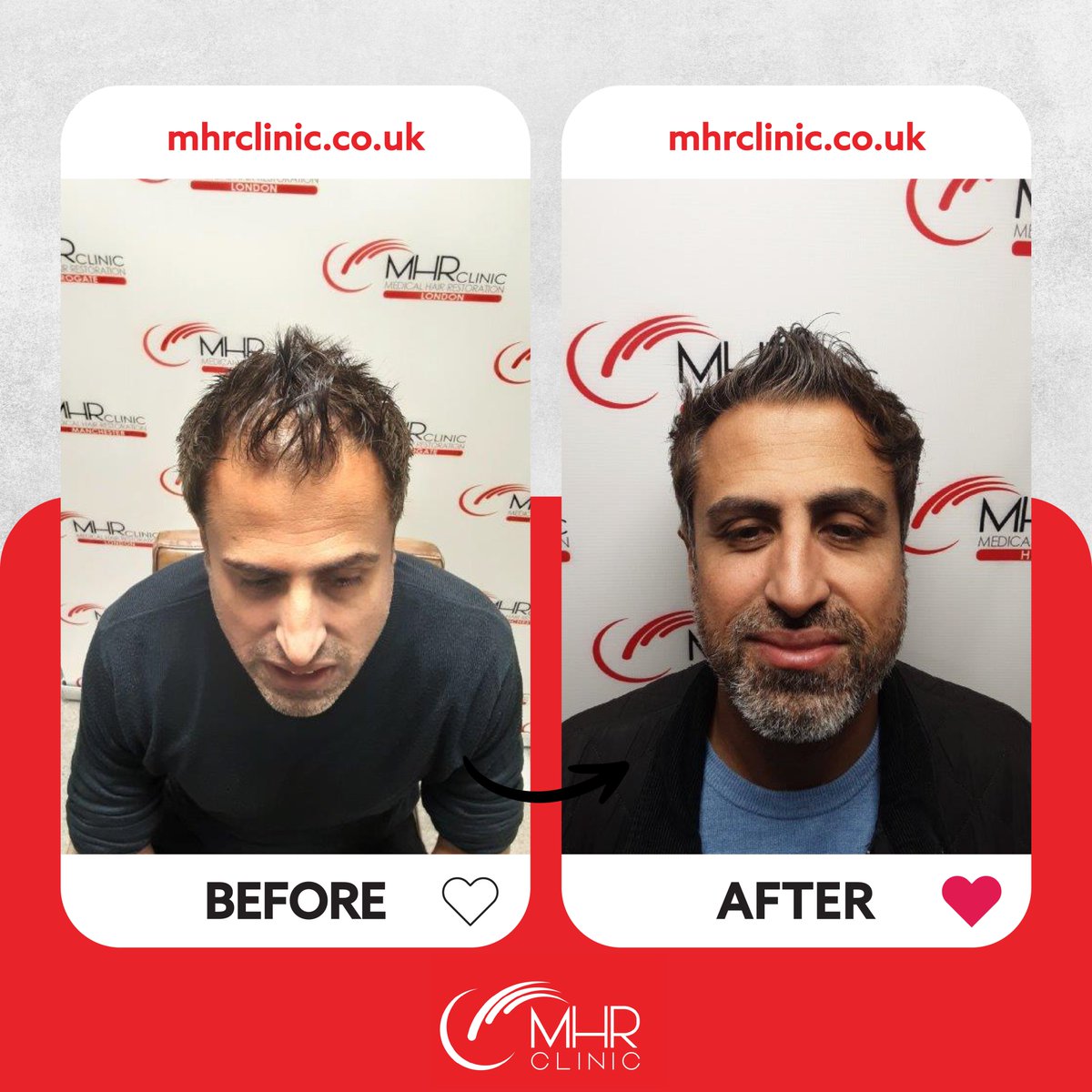 MHRClinicUK's tweet photo. 𝐵𝐸𝐹𝑂𝑅𝐸 ➡️ 𝑨𝑭𝑻𝑬𝑹  🤩💫 WOW! What a transformation for Mr AJ!

Mr. AJ's journey with MHR Clinic's 8-month LLLT course and personalised herbal prescriptions, has been nothing short of remarkable! Discover the power of science and nature combined.

#hairtransplant https://t.co/hoqc4N32TU