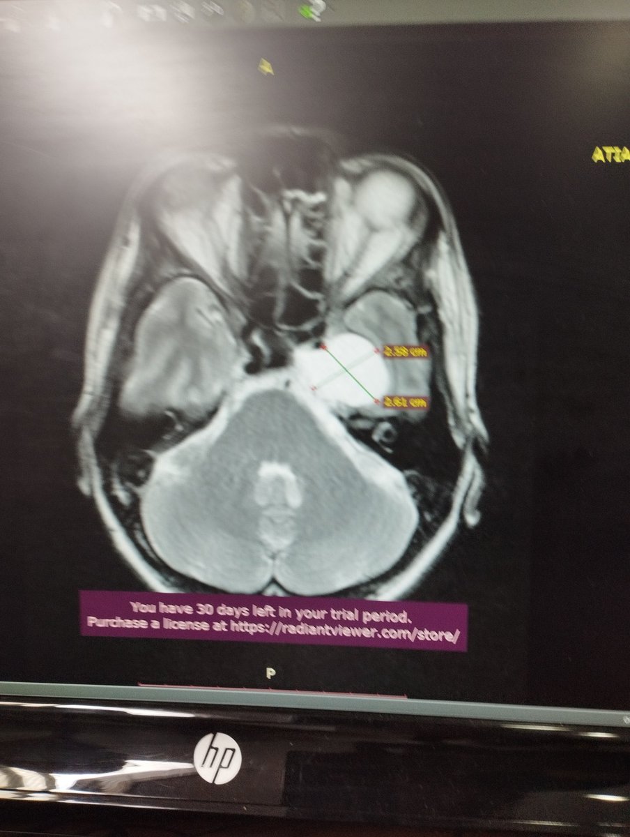 AlexaGomezDos's tweet photo. Flor 45 años, tiene un tumor cerebral. Debe realizarse una radiocirugía lo antes posible y salvar la visión derecha , ya que el lado izquierdo está comprometido. El presupuesto es de casi $5000 y en un hospital no hay cómo operarla. Su familia nos envía su campaña 🙏🏼💟 GRACIAS https://t.co/8C4PhnpHbc