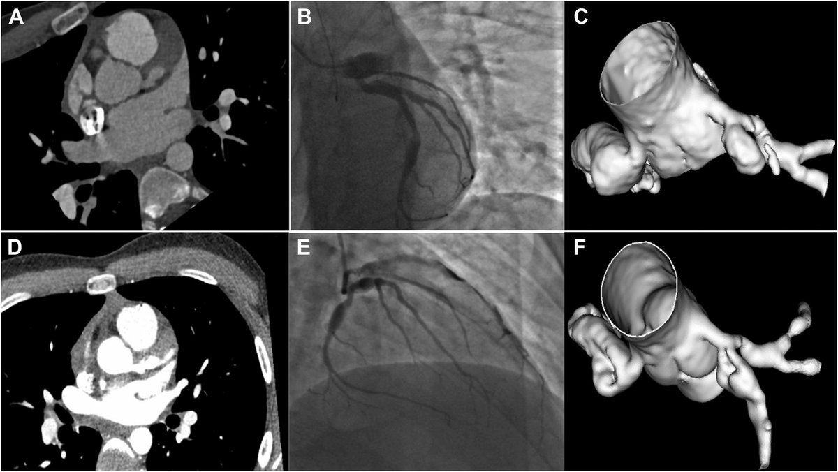 Check out our rare case of a 14 y/o w/ COVID-induced MIS-C who p/w giant LAD aneurysm c/b STEMI 😱🤯!Congrats to @realjaympatel for leading this effort and @MyJSCAI for publishing our work. @uclaCVfellows @aksoyolcay