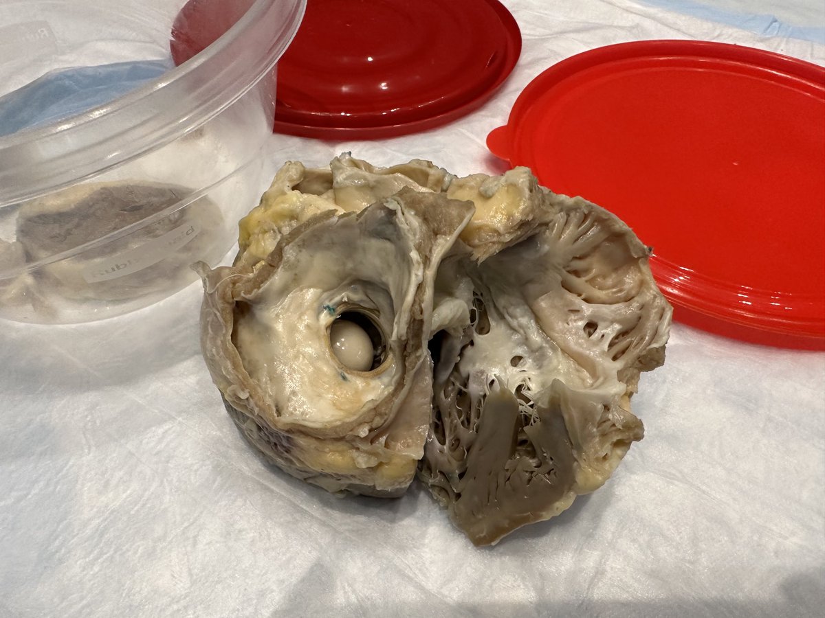 Hands on hearts! looking inside hearts ⁦@Heart_SCCT⁩ . Got to touch and feel a ball and cage valve along with other new generation transcatheter valves . Wonderful session by ⁦@stephaniesell_⁩ and co .. a different dimension to the images on CTA. #scct2023 ⁦