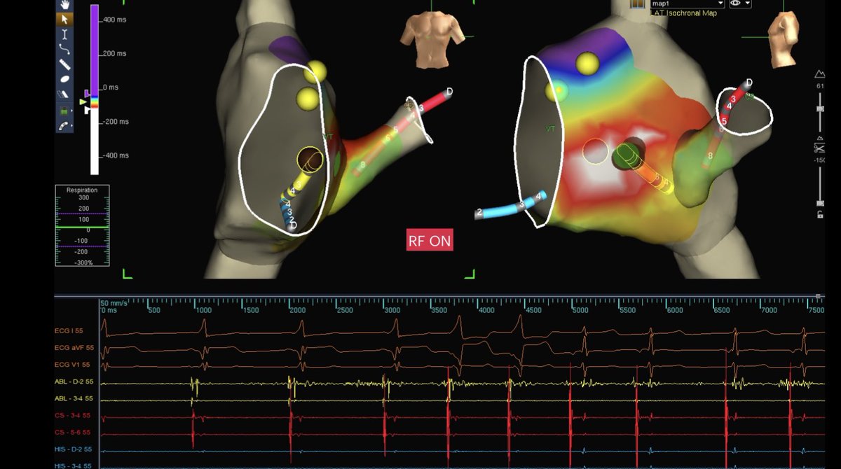 ritmogenesis's tweet photo. Ablación de WPW postero septal derecho con mapeo Tridimensional y zero fluoro. De la mano del mago @angelnet188 y @andyboch .
#zerofluoro #eppeps #fellowsfirst #WPW #ABBOTT #ensiteprecision #ritmogenesis https://t.co/DKOOVPdNM5