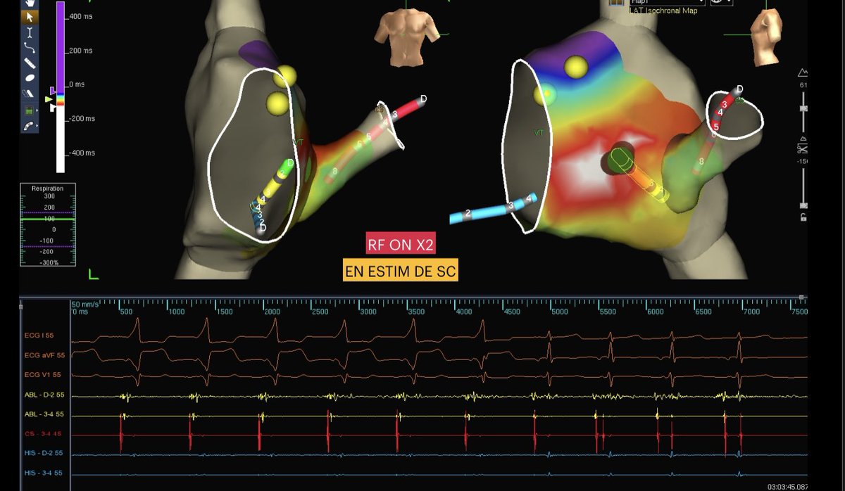 ritmogenesis's tweet photo. Ablación de WPW postero septal derecho con mapeo Tridimensional y zero fluoro. De la mano del mago @angelnet188  y @andyboch .

#zerofluoro #eppeps #fellowsfirst #WPW #ABBOTT #ensiteprecision #ritmogenesis https://t.co/DKOOVPdNM5