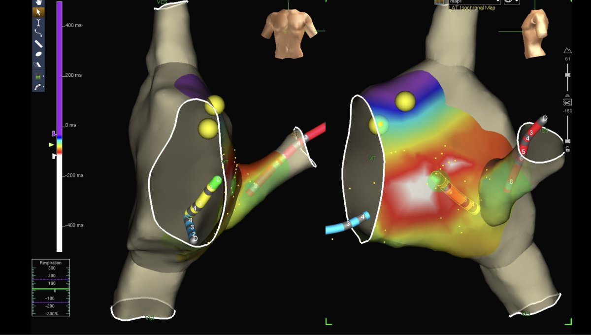 ritmogenesis's tweet photo. Ablación de WPW postero septal derecho con mapeo Tridimensional y zero fluoro. De la mano del mago @angelnet188 y @andyboch .
#zerofluoro #eppeps #fellowsfirst #WPW #ABBOTT #ensiteprecision #ritmogenesis https://t.co/DKOOVPdNM5