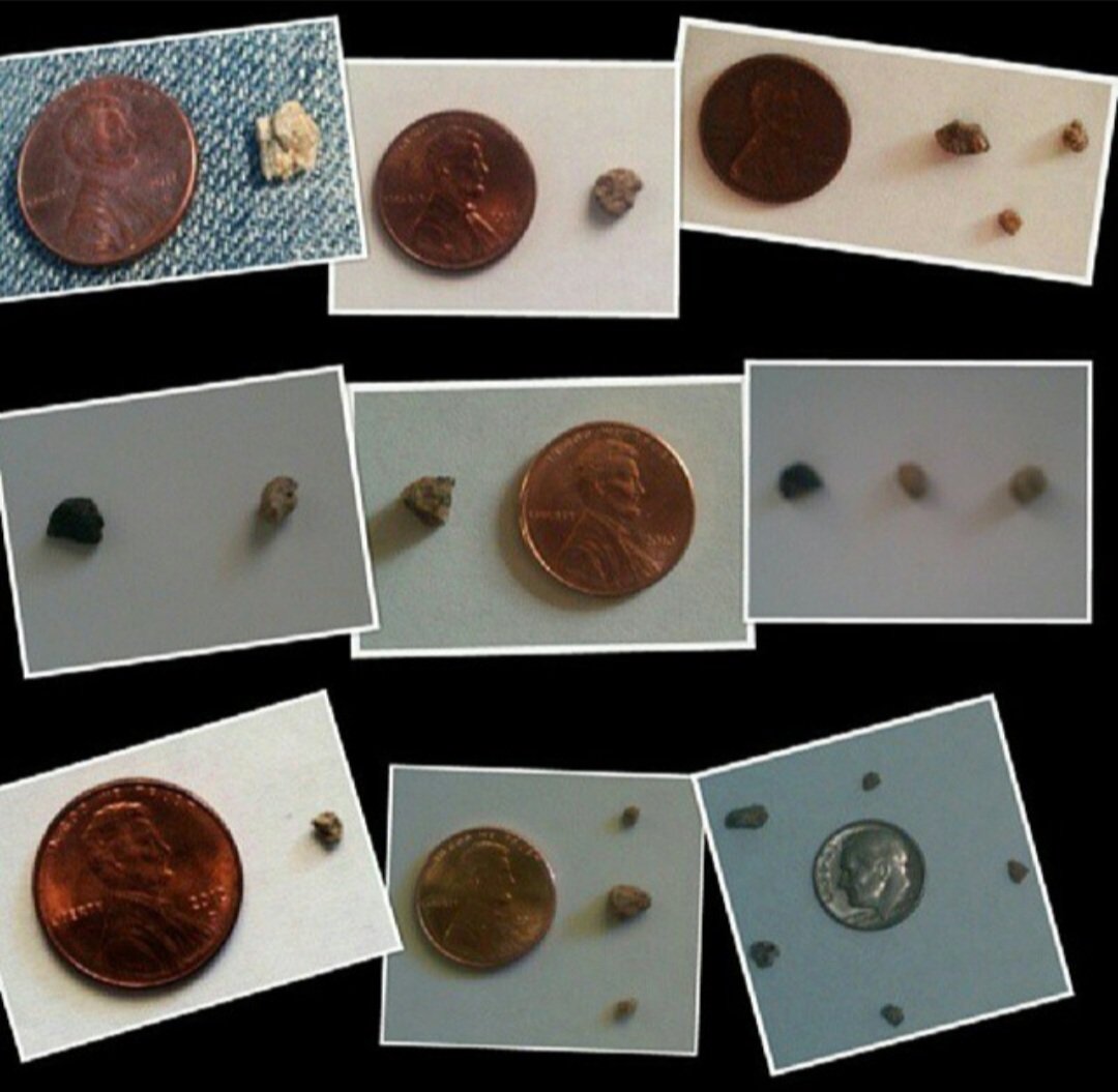 ECEU619's tweet photo. @scottculkin Nice one!!  Since August 2017, I've seen, caught or had surgically removed 473+ kidney stones.  I currently have 22 total in both kidneys &amp; three (3) hanging out in my ureter.  Here's just a few of my lil' nuggets!!  YEP, GOOD TIMES!! 👍🏼👍🏼 https://t.co/AMixQLQQ2e