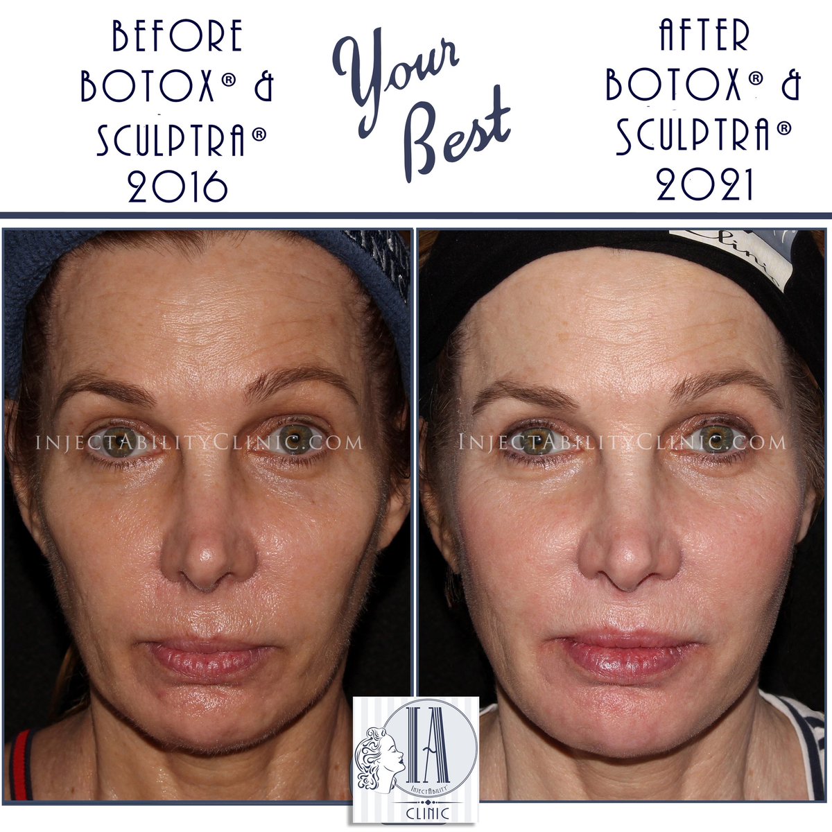 InjectAbility's tweet photo. Sculptra and Botox with #InjectAbility Book now for a buy 3 get 1 free special, while supplies last! https://t.co/KCIWloVUb1