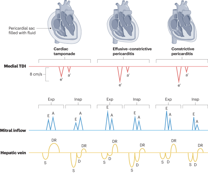 NephroP's tweet photo. Mitral tissue Doppler, mitral inflow, and hepatic vein Doppler findings in tamponade, effusive-constrictive pericarditis, and constrictive pericarditis.
#POCUS #echofirst #VExUS #MedEd 
🔗https://t.co/AzhAI8I9ZI https://t.co/zJFdiPvYlW