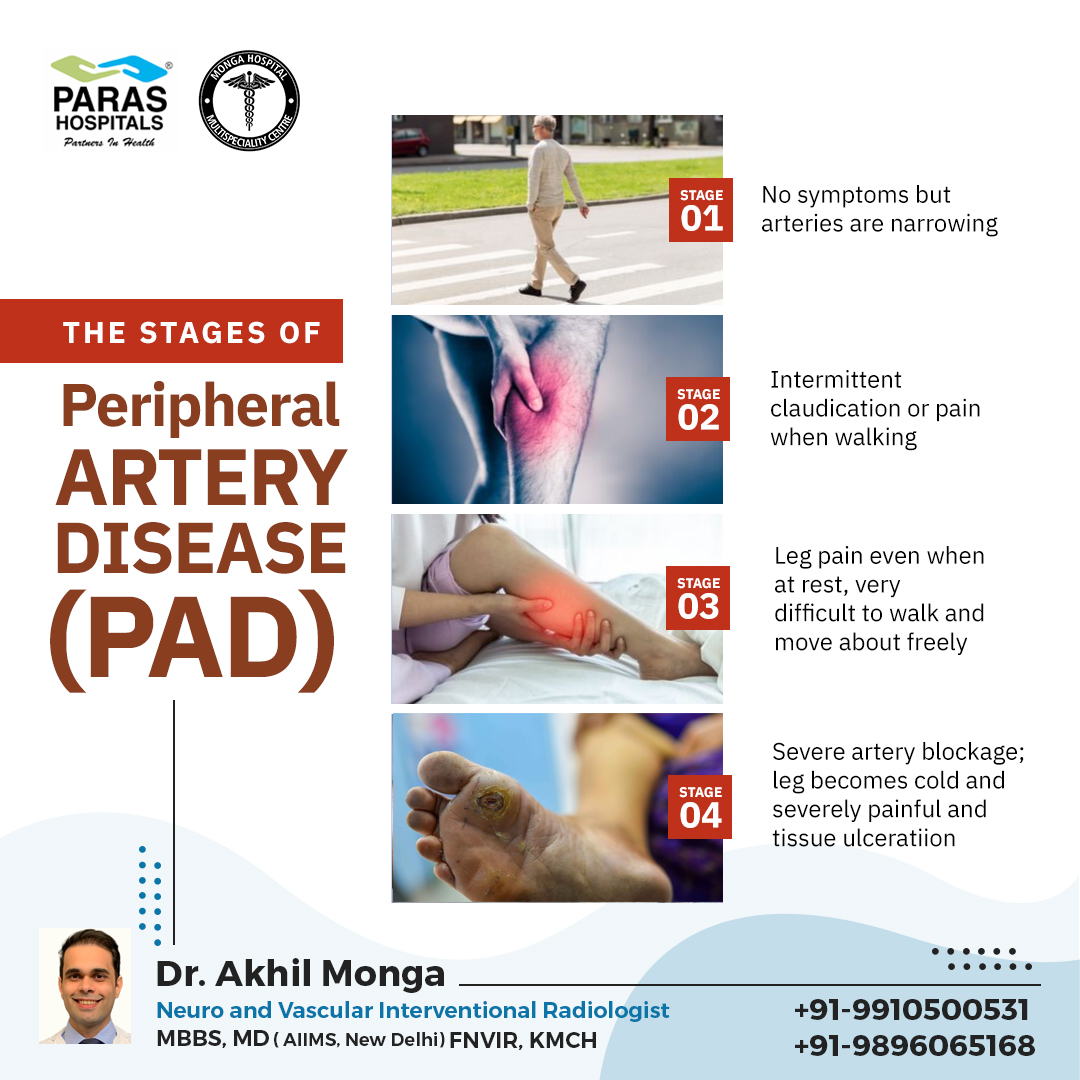PAD is a common circulatory problem in which narrowed arteries reduce blood flow to your limbs. To eliminate the diverse effects of PAD, it is necessary to watch each stage of symptoms to get it treated on time.
bit.ly/3X0x64x
#Peripheralarterydisease #PAD