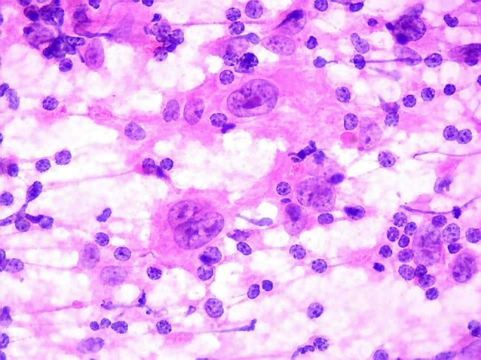 GeronimoJrLapac's tweet image. Neck Lymph node,17yo.

Dx?

#cytopath #pathology