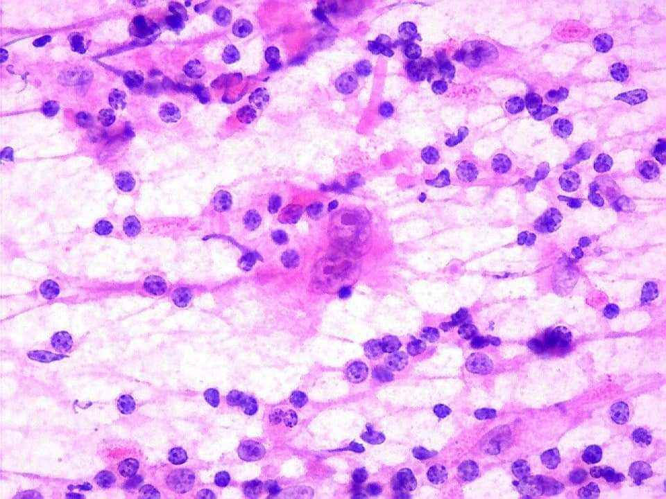 GeronimoJrLapac's tweet image. Neck Lymph node,17yo.

Dx?

#cytopath #pathology