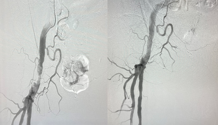 ShockwaveIVL's tweet photo. Astounding result for the Surgical Specialists of SWFL in this standalone #ShockwaveIVL CFA case! Patient was treated with atherectomy & PTA a few months prior. After 180 pulses of 7.0x60 #ShockwaveM5Plus the patient saw improved outcomes.
US Rx only. ISI https://t.co/sZ0NdzXNcV https://t.co/FLEI9vGb6b