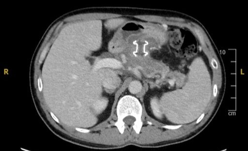 Derby Pancreaticobiliary & Robotic AWR Unit tweet media