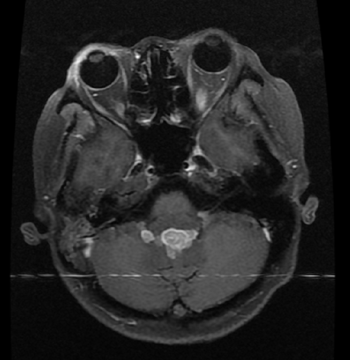 DGJournals's tweet photo. Open Life Sciences | Vol. 18
Granulomatous polyangiitis involving the fourth ventricle: Report of a rare case and a literature review
▶️https://t.co/cyRpXN3SV7
#polyangiitis #granulomatosis #vasculitis