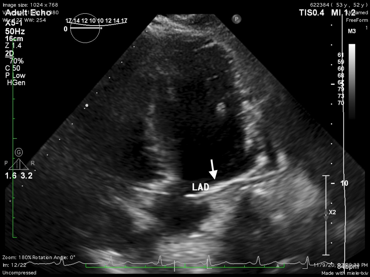 ShawnMasoumi's tweet photo. Masoumi S, Separham A, Parizad R, Jafarisis S, Assefi M. Dual Left Anterior Descending Artery: Clinical Overview and Interventional Management. J Tehran Heart Cent. 2023;18(2):146-150. https://t.co/NtwjUdx96D