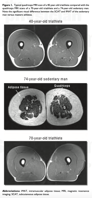 La perdita della massa muscolare ha enormi impatti sulla salute sia individuale che sociale e la principale causa è il disuso, non l’invecchiamento.

Nell’immagine potete osservare una comparazione tra una scansione MRI (risonanza magnetica) del quadricipite di un triatleta di 40
